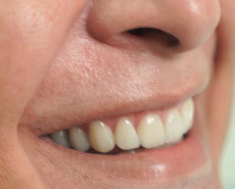 Tratamiento Cerámico Dental